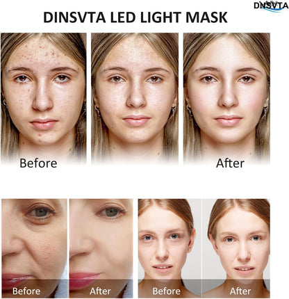 Before and after results using the DINSVTA LED light mask showcasing skin improvement, highlighting LED face mask benefits.